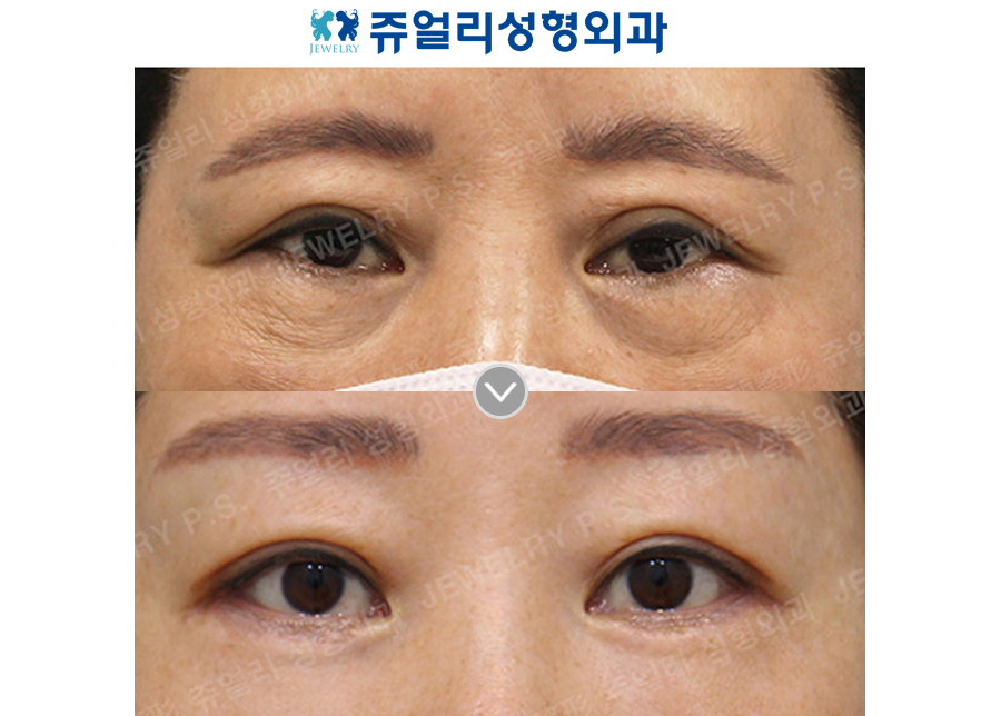 Double Eyelid Reoperation, Lower Blepharoplasty Reoperation