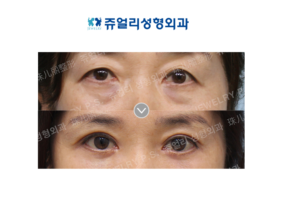 Upper Blepharoplasty, Lower Blepharoplasty