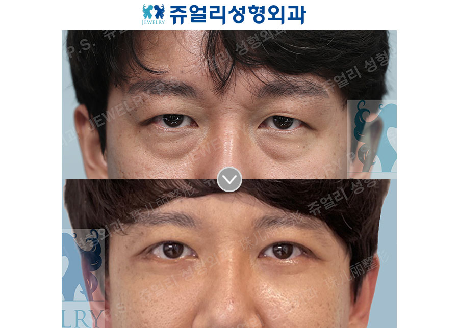 Upper+Lower Blepharoplasty