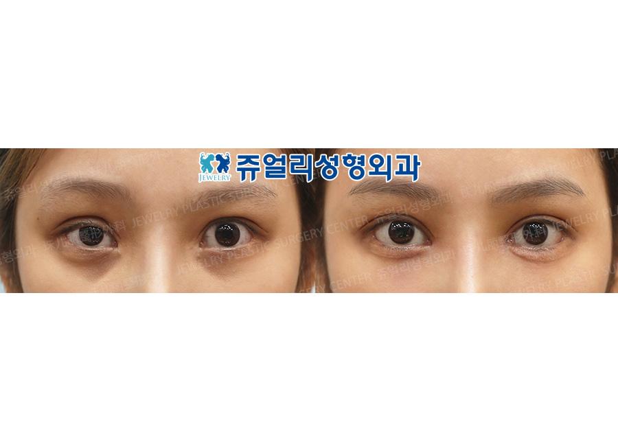 korean eyes before and after