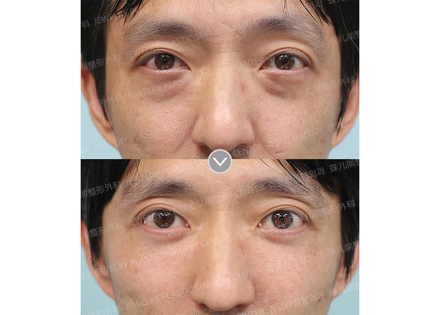 Lower blepharoplasty, Midface lifting