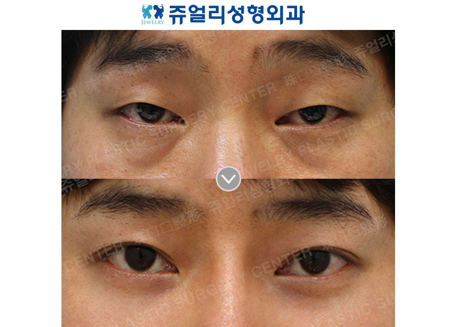 Non-Incisional Ptosis Correction, Dark Circle Removal