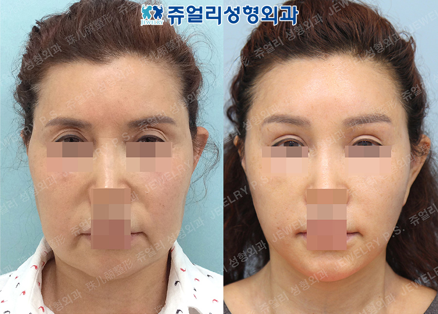 Fat Grafting, Cheek+Double Chin Liposuction, Forehead Lifting, Face Lifting, Neck Lifting Reoperation (Fix ear deformity, remove scars)