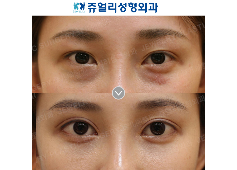 Double Eyelids Reoperation, Epi+Lateral+Lower Lateral Canthoplasty, Fat-Repositioning Transconjunctival + Loveband