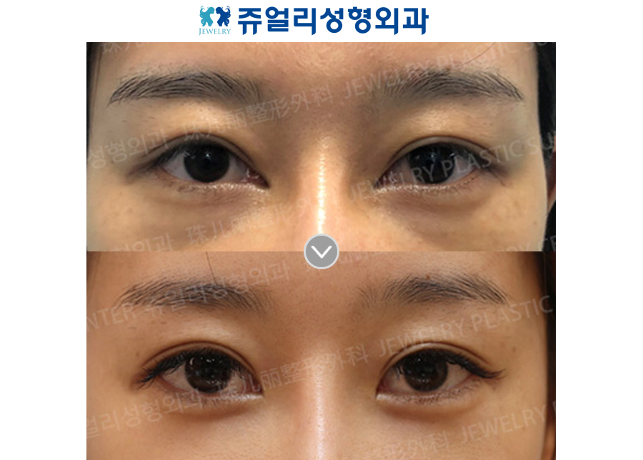 Fat-Repositioning Transconjunctival + Loveband