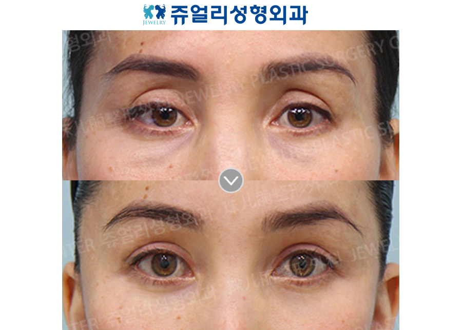 Double Eyelids Reoperation (Ptosis)+ Upper Eyelid Fat Grafting + Lower Blepharoplasty