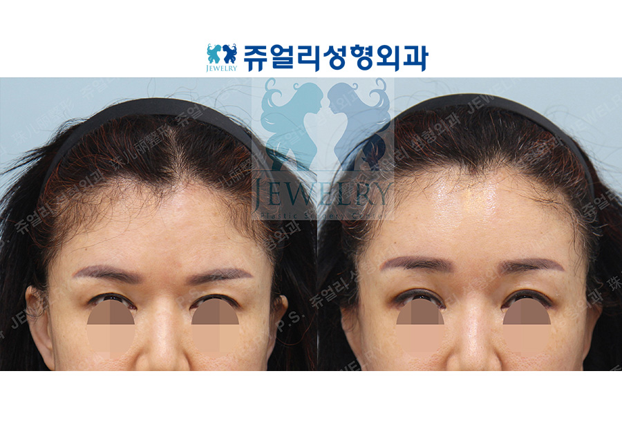 Forehead Lifting