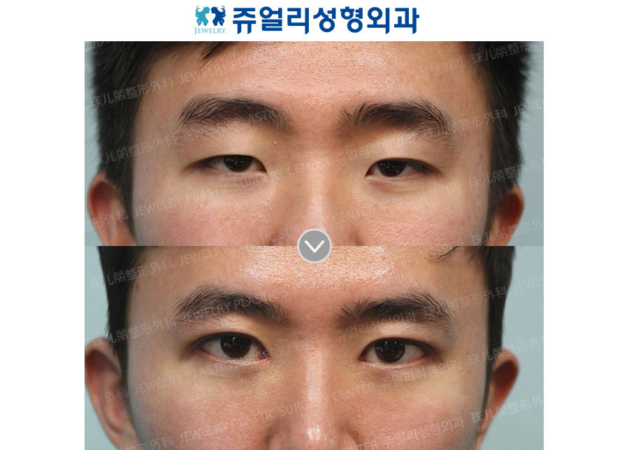 Ptosis + Epicanthoplasty