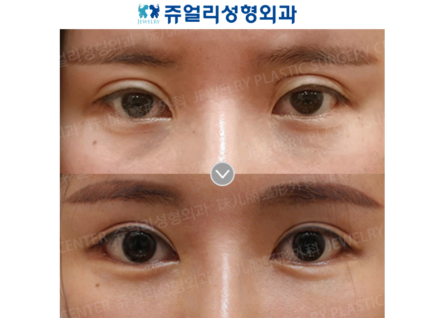 Double Eyelids Reoperation, Epi+Lateral+Lower Lateral Canthoplasty, Fat-Repositioning Transconjunctival