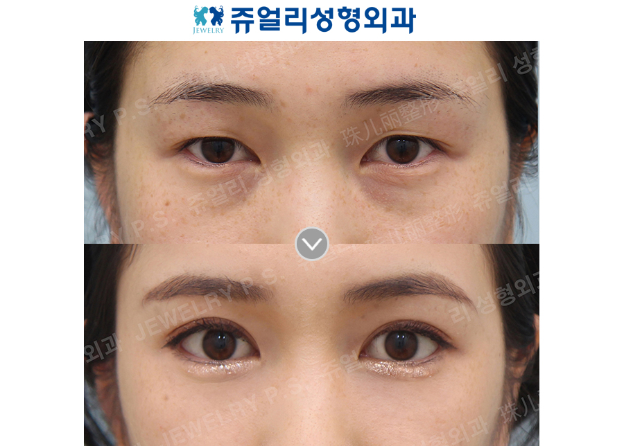 Double Eyelid, Dark Circle (Fat-Repositioning Transconjunctival Blepharo, Loveband X), Lower Lateral Canthoplasty/Lowering down the eyes tail