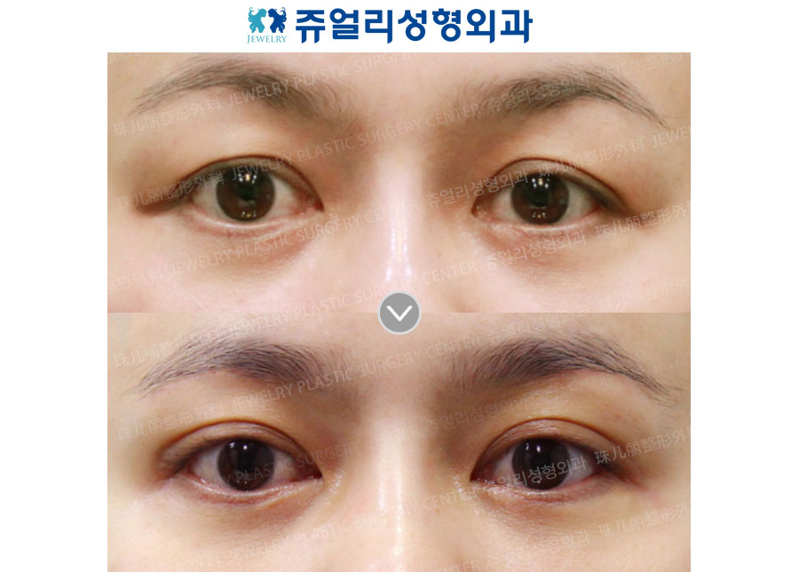 Sub brow lift